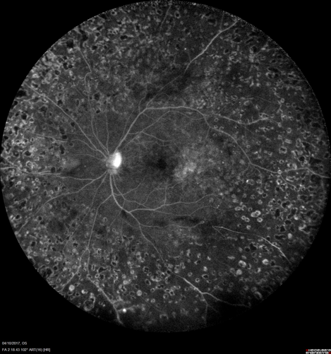 angiographie rétinienne