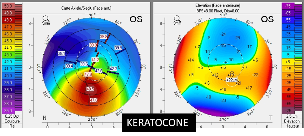 Paris rétina vision Topo cornéenne keratocone