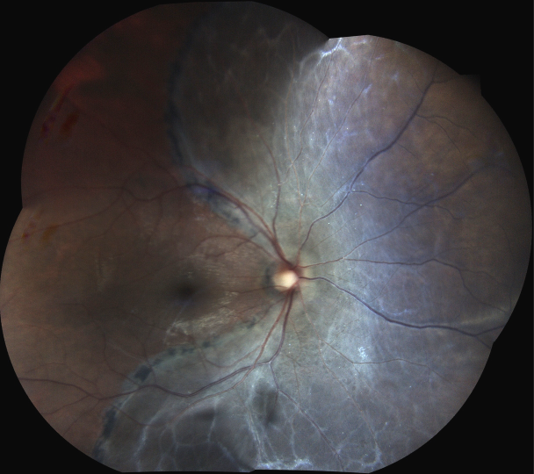 Paris rétina vision - rétinographie