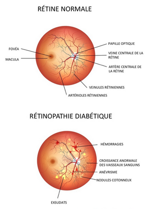 Paris rétina vision - rétinopathie diabétique